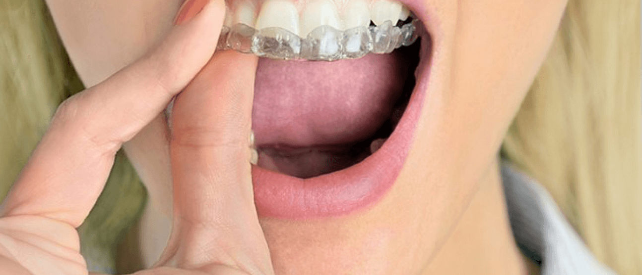 Is Invisalign Better Than Braces For Sensitive Teeth?