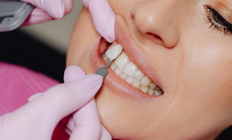 What are Dental Veneers and How Can They Improve Your Smile?